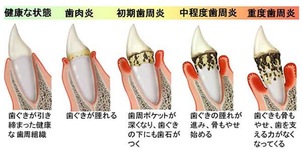図で見る歯周病の進行度