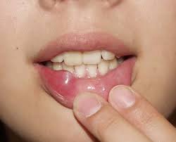 唇が腫れてしまったけど なかなか治らない ガンかも という 不安いっぱいで来られる患者さんが 時々いらっしゃいます