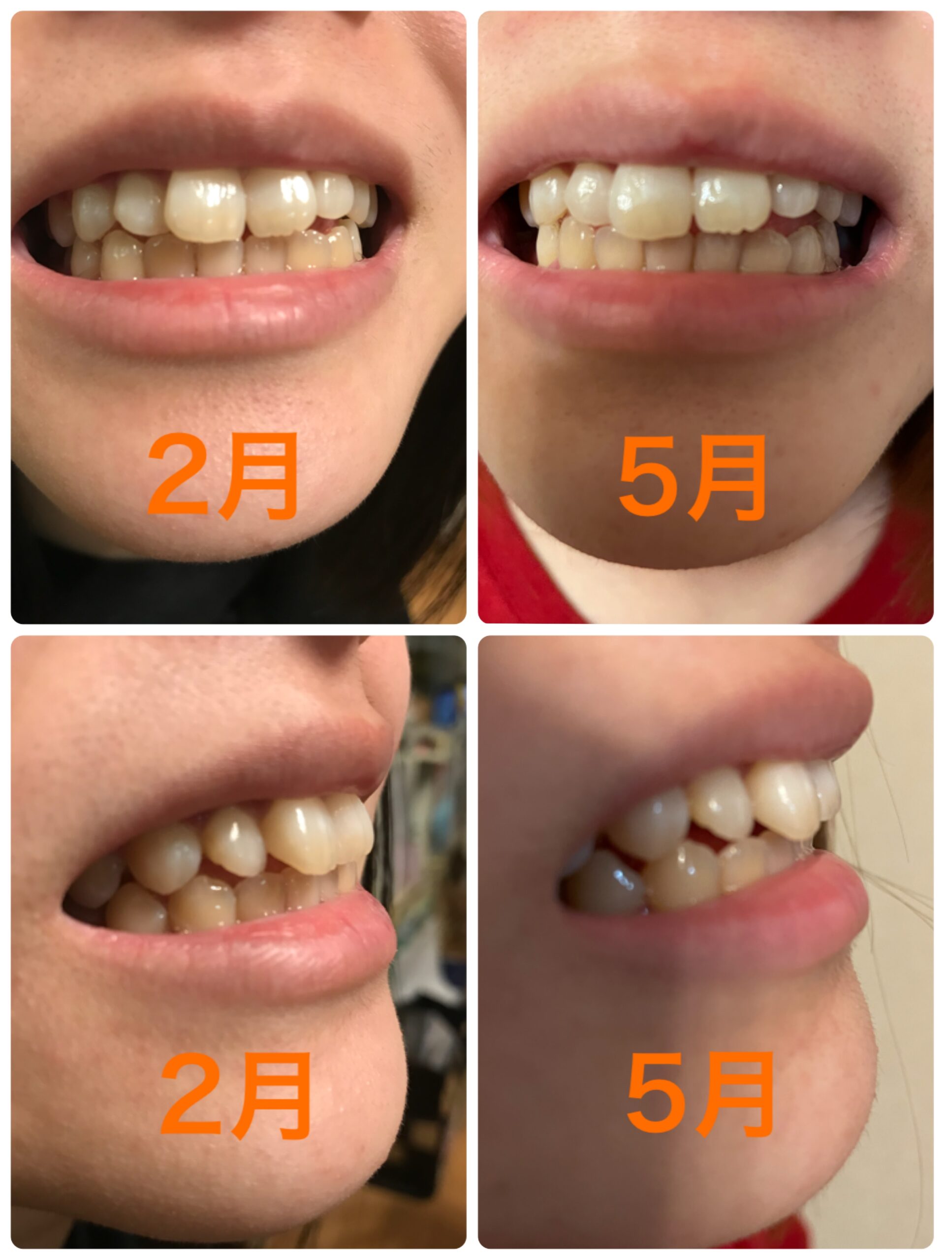 娘がマウスピース矯正を始めて約3ヶ月が経ちました その 医療法人さかの歯科 京都市西京区の歯医者ならさかの歯科