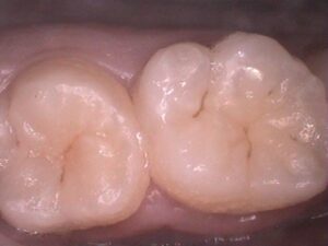 奥歯の溝の初期虫歯