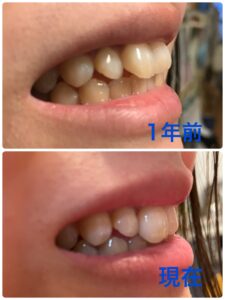 矯正1年後の写真