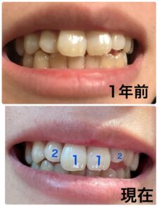 矯正1年後正面の写真