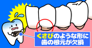 くさび状欠損