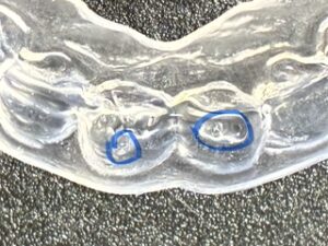 ホワイトニングトレー