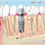 ｲﾝﾌﾟﾗﾝﾄ１