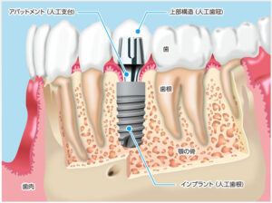 ｲﾝﾌﾟﾗﾝﾄ１