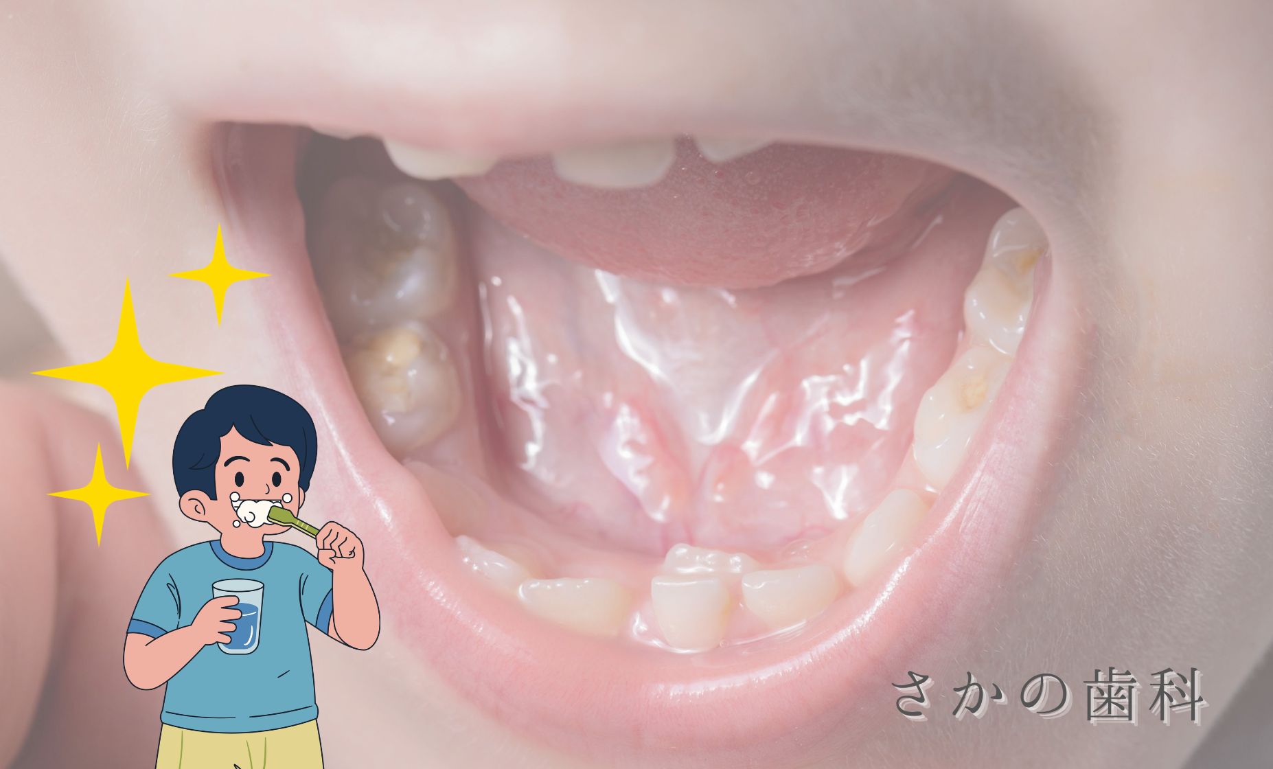 ６歳臼歯