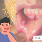 口内炎