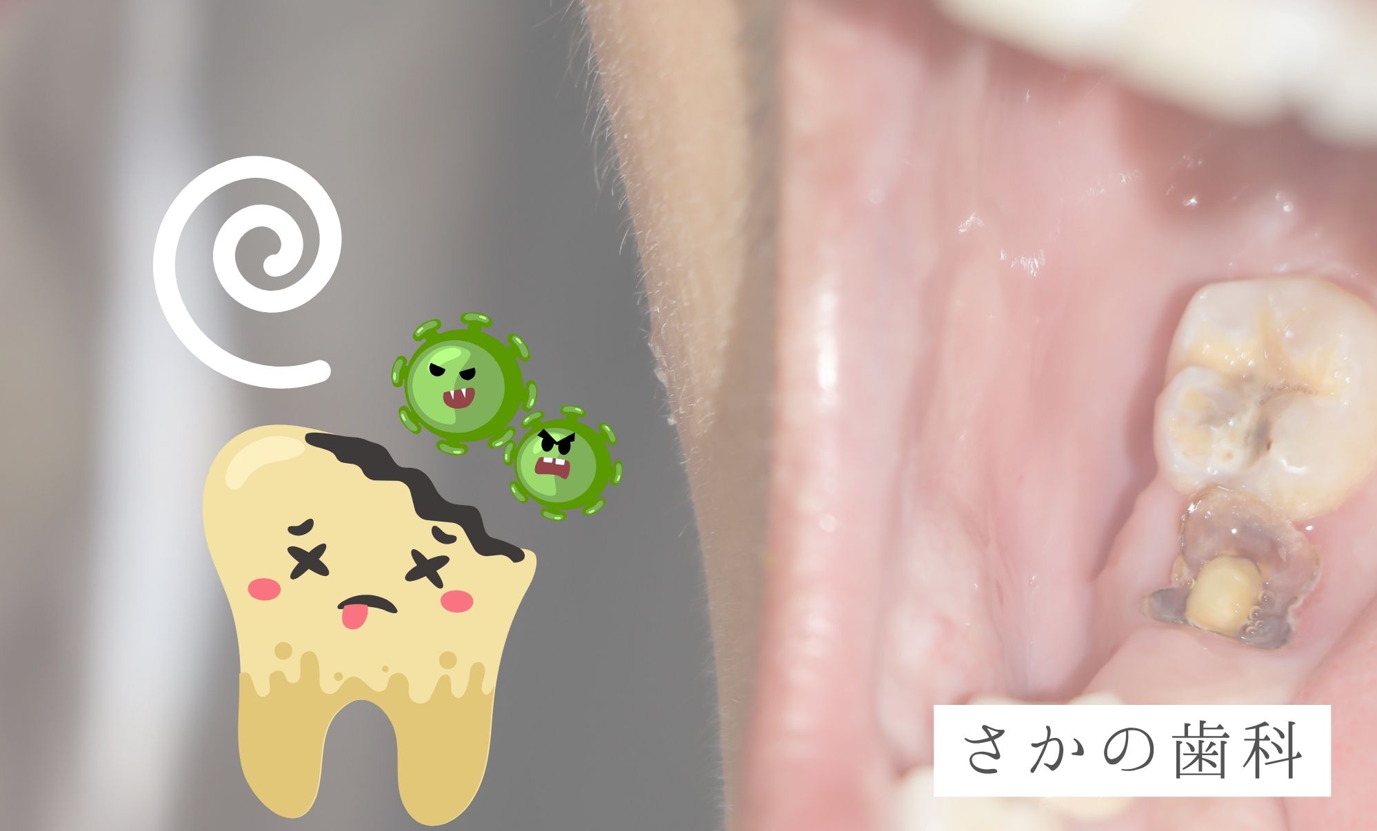 エナメル質形成不全